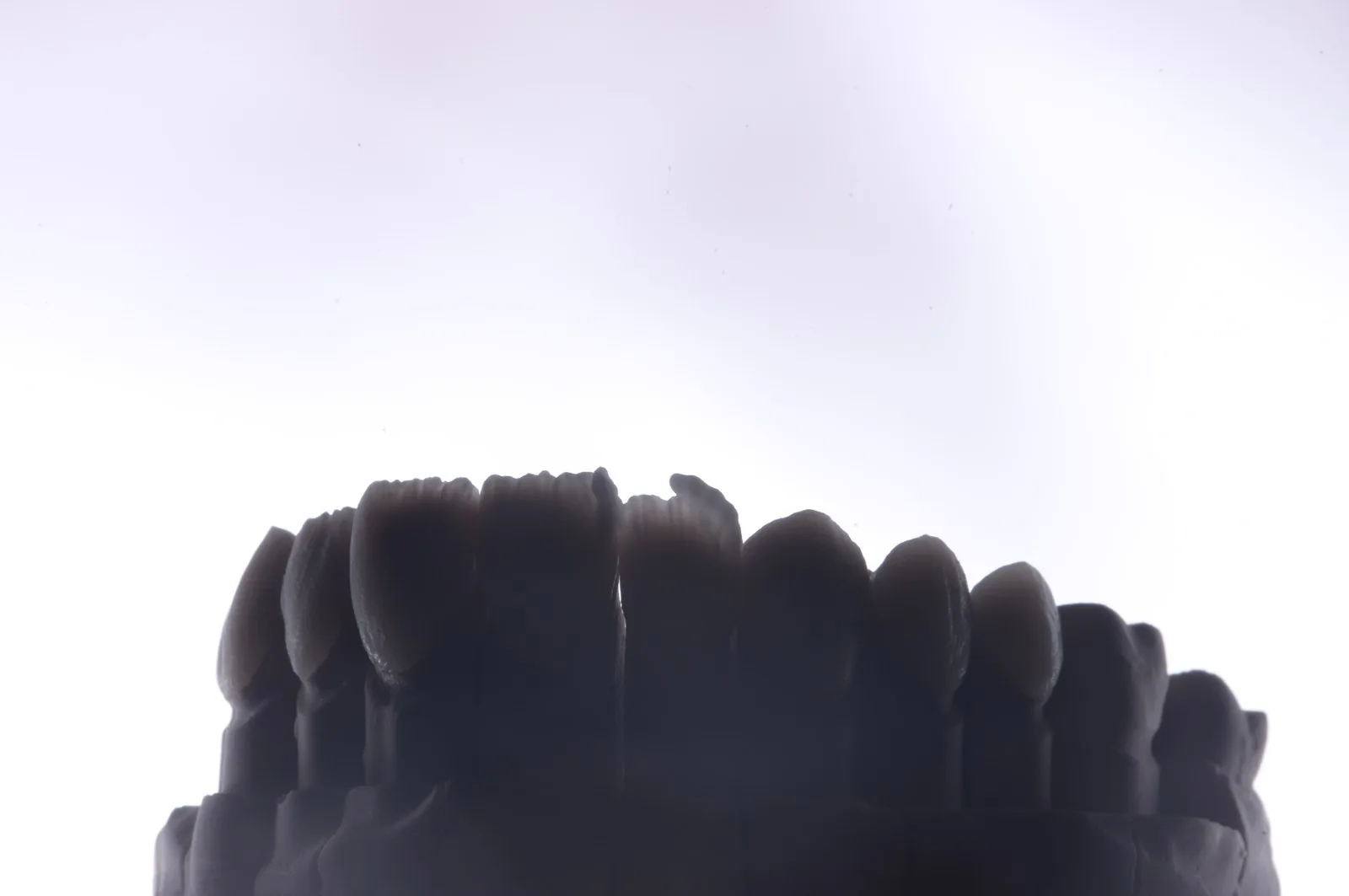 A full arch of veneers on a dark model in the dental lab