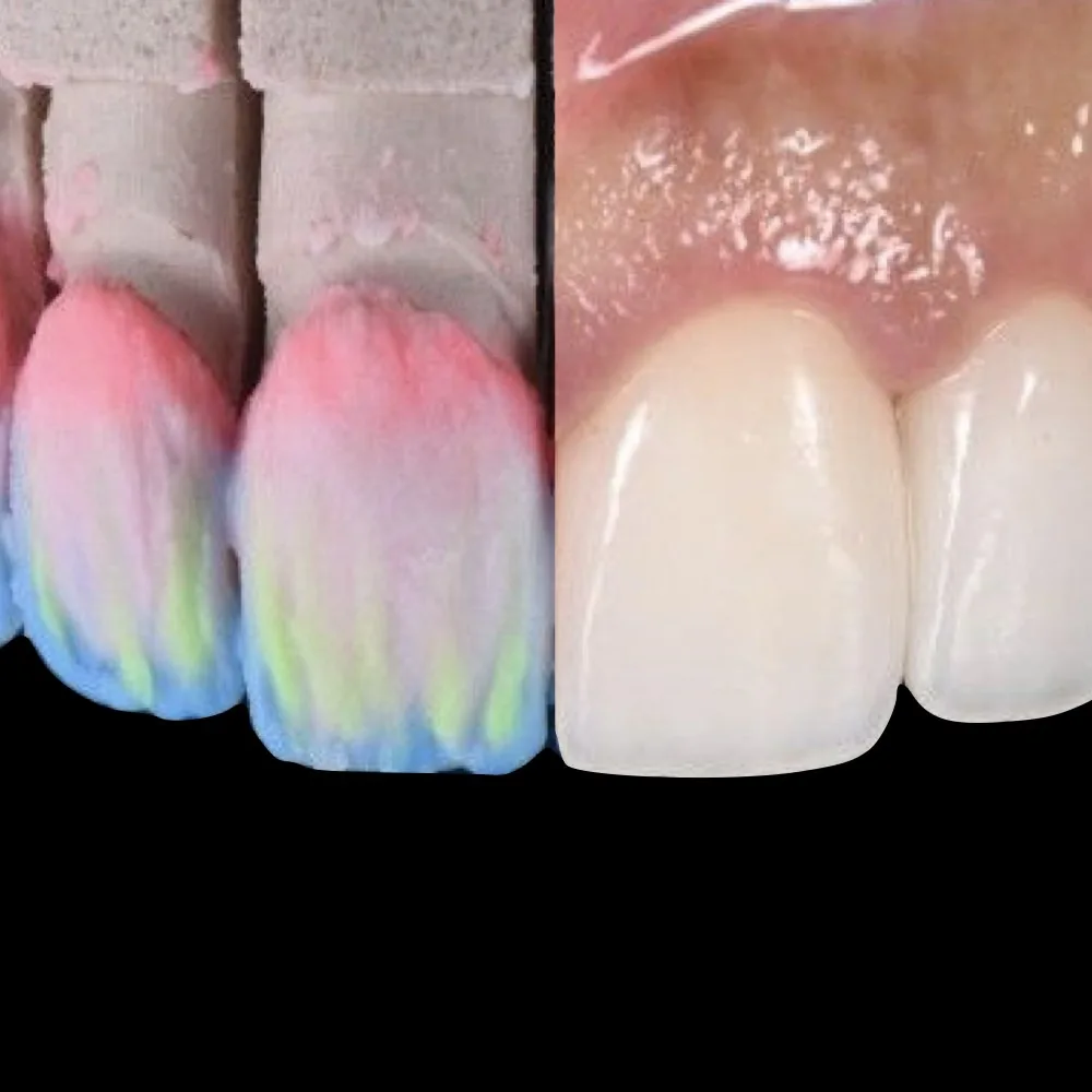 Two refractory-stage restorations colored to map porcelain layers beside the finished natural-looking crowns