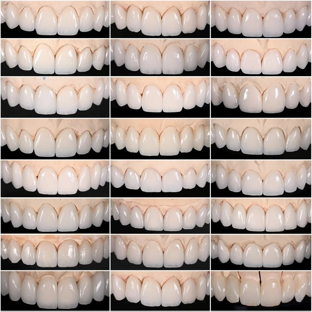 Grid of finished porcelain veneer cases on stone models