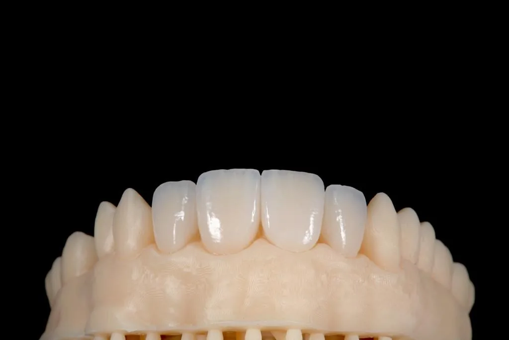 Layered porcelain veneers seated on a dental model against a black background