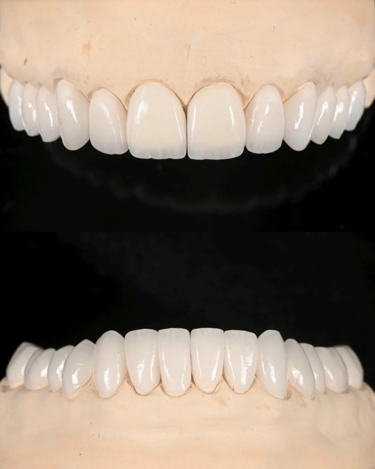 Upper and lower porcelain veneers seated on stone models against black