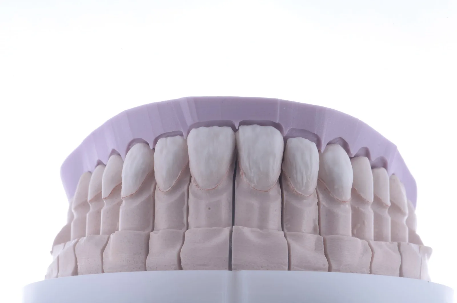 A diagnostic wax-up on a stone model in the dental lab
